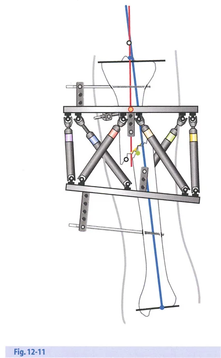 صورة طبية: تصحيح تشوهات العظام بتقنيات بالي المتقدمة الدليل الشامل للمرضى مع الأستاذ الدكتور محمد هطيف