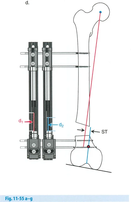 صورة طبية: تصحيح تشوهات العظام بتقنيات بالي المتقدمة الدليل الشامل للمرضى مع الأستاذ الدكتور محمد هطيف
