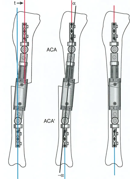 صورة طبية: تصحيح تشوهات العظام بتقنيات بالي المتقدمة الدليل الشامل للمرضى مع الأستاذ الدكتور محمد هطيف