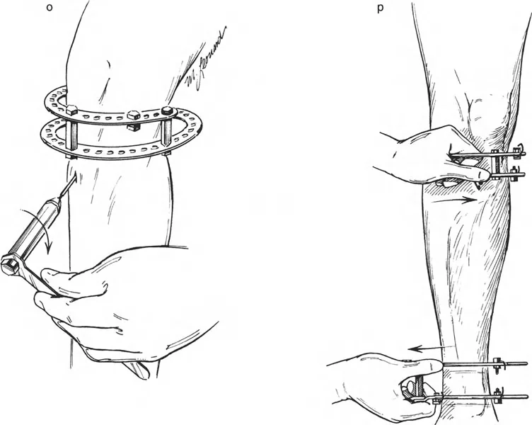 صورة طبية: تصحيح تشوهات العظام بتقنيات بالي المتقدمة الدليل الشامل للمرضى مع الأستاذ الدكتور محمد هطيف