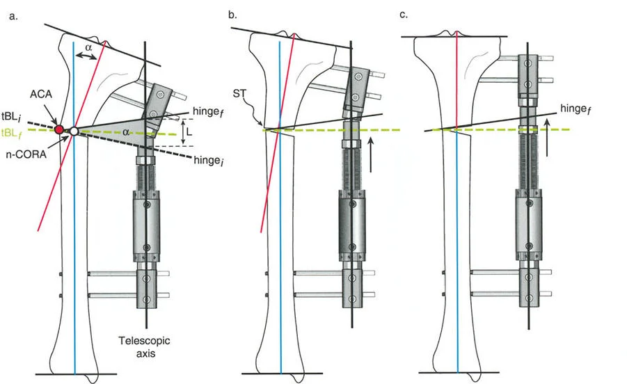 صورة طبية: تصحيح تشوهات العظام بتقنيات بالي المتقدمة الدليل الشامل للمرضى مع الأستاذ الدكتور محمد هطيف