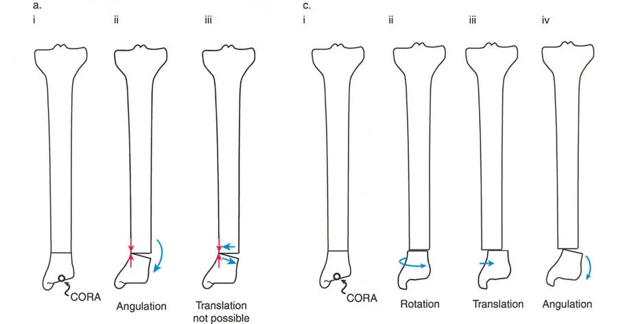 صورة طبية: تصحيح تشوهات العظام بتقنيات بالي المتقدمة الدليل الشامل للمرضى مع الأستاذ الدكتور محمد هطيف