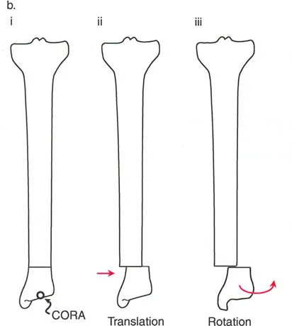 صورة طبية: تصحيح تشوهات العظام بتقنيات بالي المتقدمة الدليل الشامل للمرضى مع الأستاذ الدكتور محمد هطيف