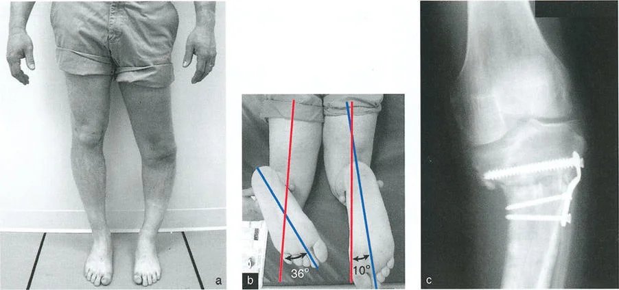 صورة طبية: السيطرة الكاملة على تشوهات العظام المعقدة: تصحيح دقيق بستة محاور مع الأستاذ الدكتور محمد هطيف