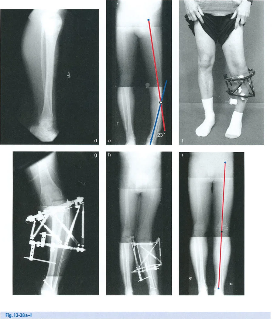صورة طبية: السيطرة الكاملة على تشوهات العظام المعقدة: تصحيح دقيق بستة محاور مع الأستاذ الدكتور محمد هطيف