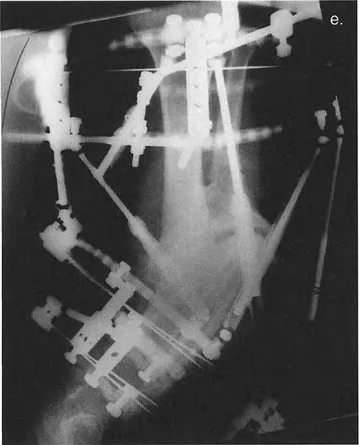 صورة توضيحية لـ السيطرة الكاملة على تشوهات العظام المعقدة: تصحيح دقيق بستة محاور مع الأستاذ الدكتور محمد هطيف