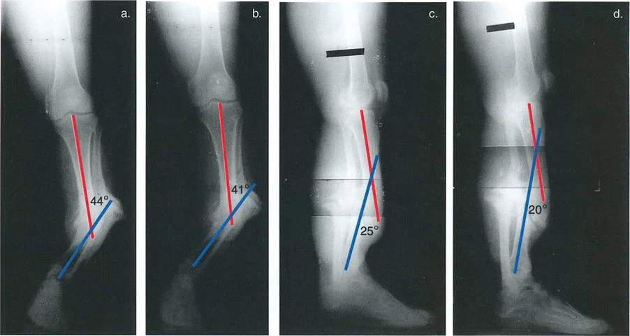 صورة توضيحية لـ السيطرة الكاملة على تشوهات العظام المعقدة: تصحيح دقيق بستة محاور مع الأستاذ الدكتور محمد هطيف