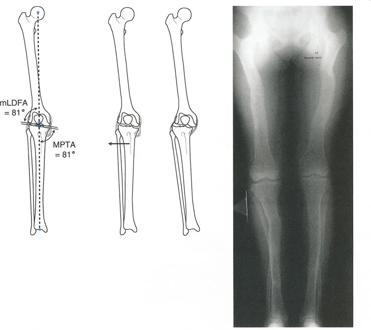 صورة طبية: تقويم تشوهات الأطراف السفلية واختلال المحاذاة: مبادئ بالي وخبرة الأستاذ الدكتور محمد هطيف