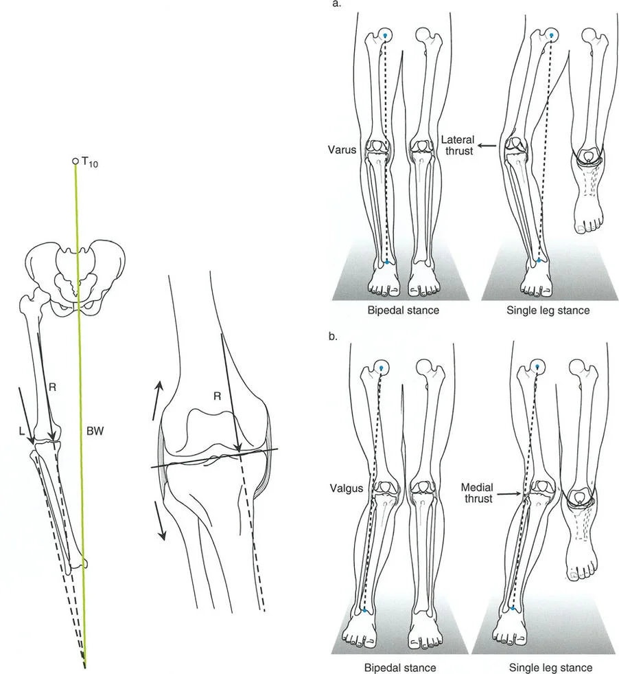 صورة توضيحية لـ تقويم تشوهات الأطراف السفلية واختلال المحاذاة: مبادئ بالي وخبرة الأستاذ الدكتور محمد هطيف
