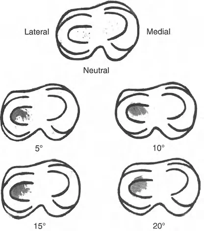 صورة طبية: تقويم تشوهات الأطراف السفلية واختلال المحاذاة: مبادئ بالي وخبرة الأستاذ الدكتور محمد هطيف