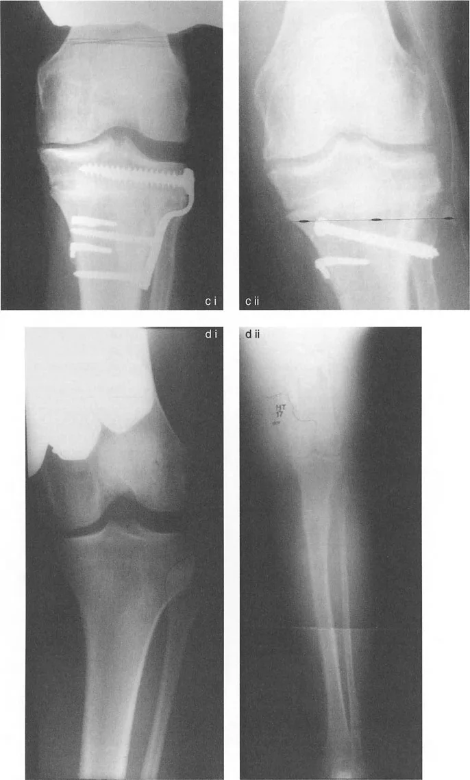 تقويم تشوهات الأطراف السفلية واختلال المحاذاة: مبادئ بالي وخبرة الأستاذ الدكتور محمد هطيف