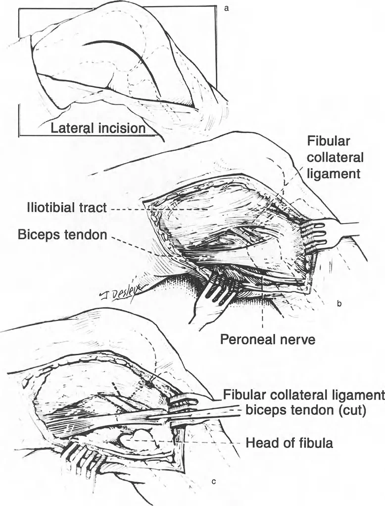 صورة توضيحية لـ تقويم تشوهات الأطراف السفلية واختلال المحاذاة: مبادئ بالي وخبرة الأستاذ الدكتور محمد هطيف