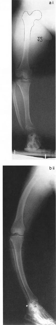 صورة طبية: تقويم تشوهات الأطراف السفلية واختلال المحاذاة: مبادئ بالي وخبرة الأستاذ الدكتور محمد هطيف