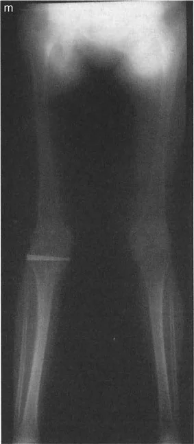صورة توضيحية لمرونة لقمة عظم الفخذ المستديرة في استيعاب التشوهات