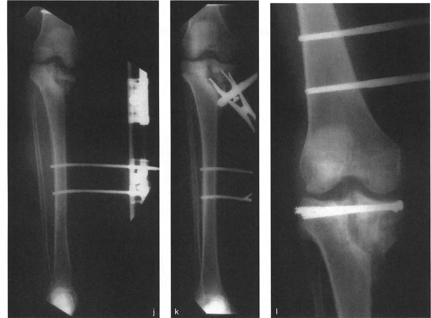 صورة توضيحية لسوء توجيه لقمة عظم الفخذ