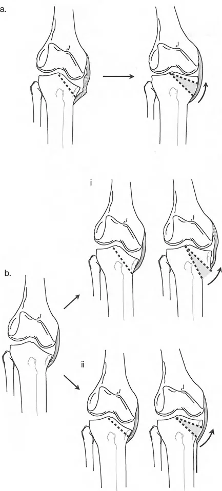 صورة توضيحية لـ تشوه خط مفصل الركبة: دليل شامل للعلاج وإعادة التأهيل مع الأستاذ الدكتور محمد هطيف