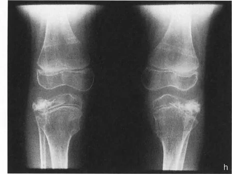 صورة توضيحية للزاوية التوافقية لخط مفصل الركبة الطبيعي