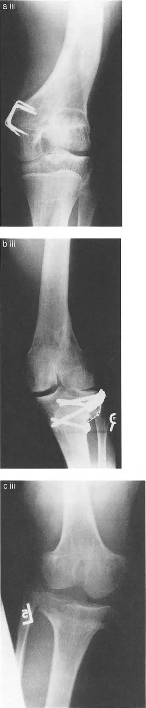 صورة توضيحية لـ تشوه خط مفصل الركبة: دليل شامل للعلاج وإعادة التأهيل مع الأستاذ الدكتور محمد هطيف