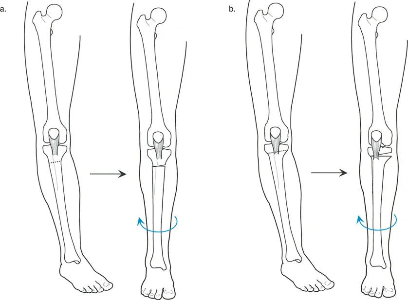 جراحة إعادة محاذاة الركبة لعلاج خشونة المفصل أحادية الحجرة: حلول متقدمة مع الأستاذ الدكتور محمد هطيف