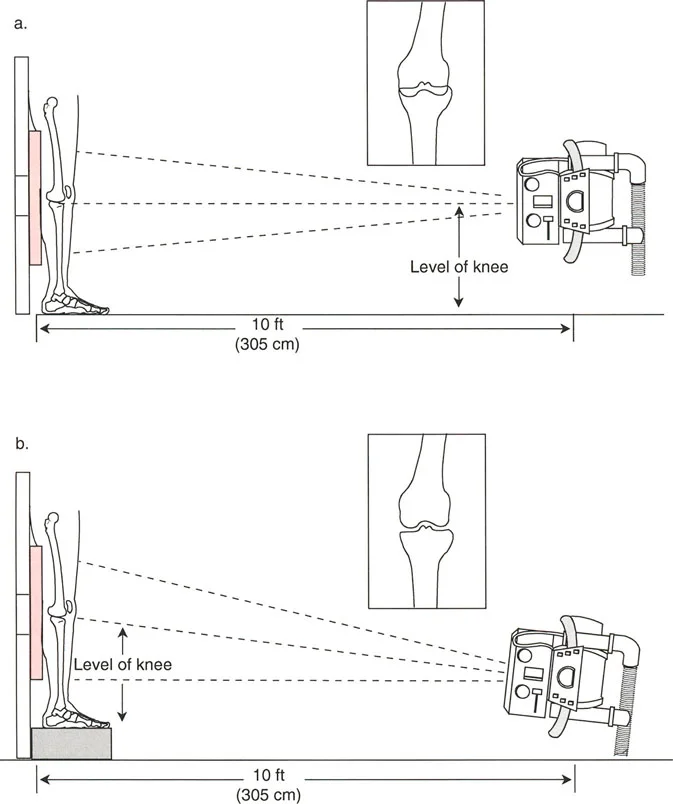 Chapter 5: . Malalignment and Malorientation in the Frontal Plane ..