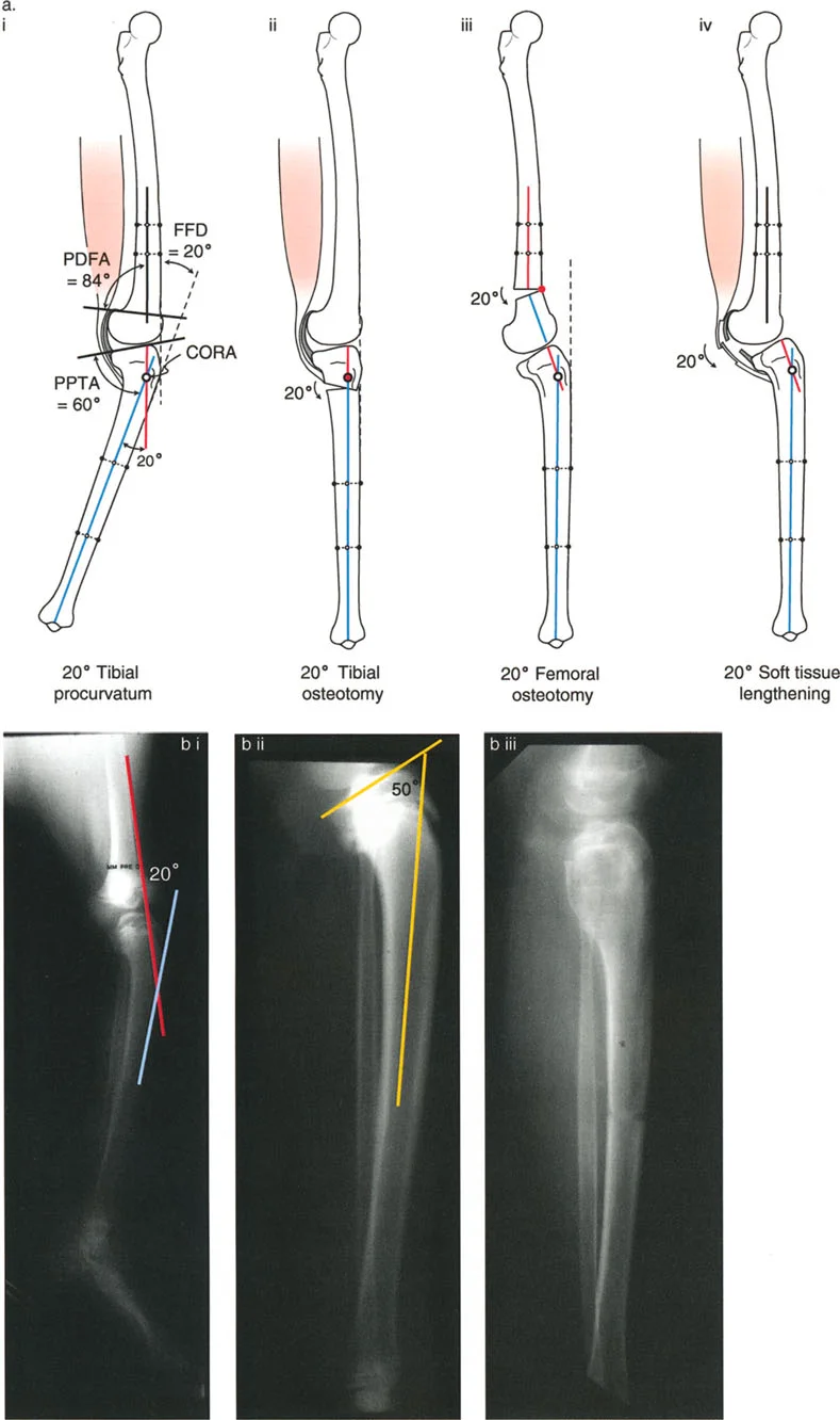صورة توضيحية لـ جراحة إعادة تنظيم الركبة: حل متقدم لخشونة المفصل أحادي الحجرة وتشوهات الركبة