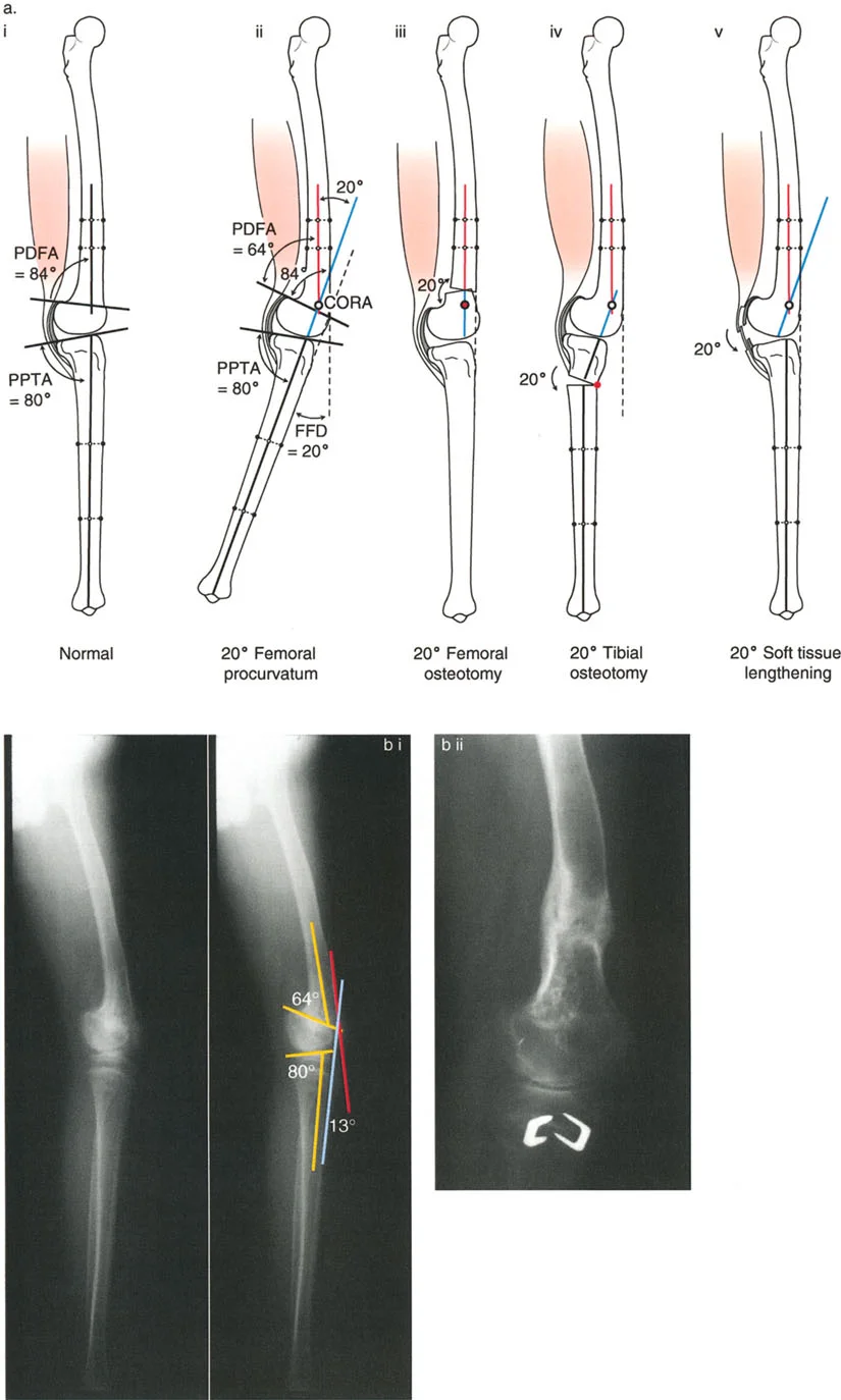 جراحة إعادة تنظيم الركبة: حل متقدم لخشونة المفصل أحادي الحجرة وتشوهات الركبة