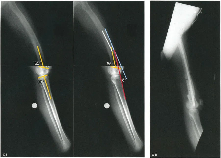 صورة توضيحية لـ جراحة إعادة تنظيم الركبة: حل متقدم لخشونة المفصل أحادي الحجرة وتشوهات الركبة