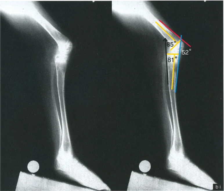 صورة طبية: جراحة إعادة تنظيم الركبة: حل متقدم لخشونة المفصل أحادي الحجرة وتشوهات الركبة