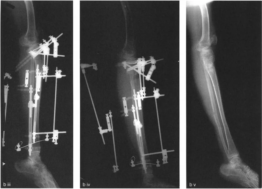 صورة طبية: جراحة إعادة تنظيم الركبة: حل متقدم لخشونة المفصل أحادي الحجرة وتشوهات الركبة