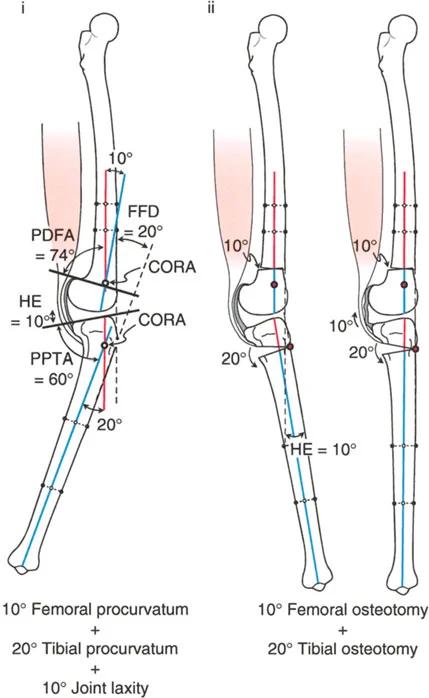 صورة طبية: جراحة إعادة تنظيم الركبة: حل متقدم لخشونة المفصل أحادي الحجرة وتشوهات الركبة