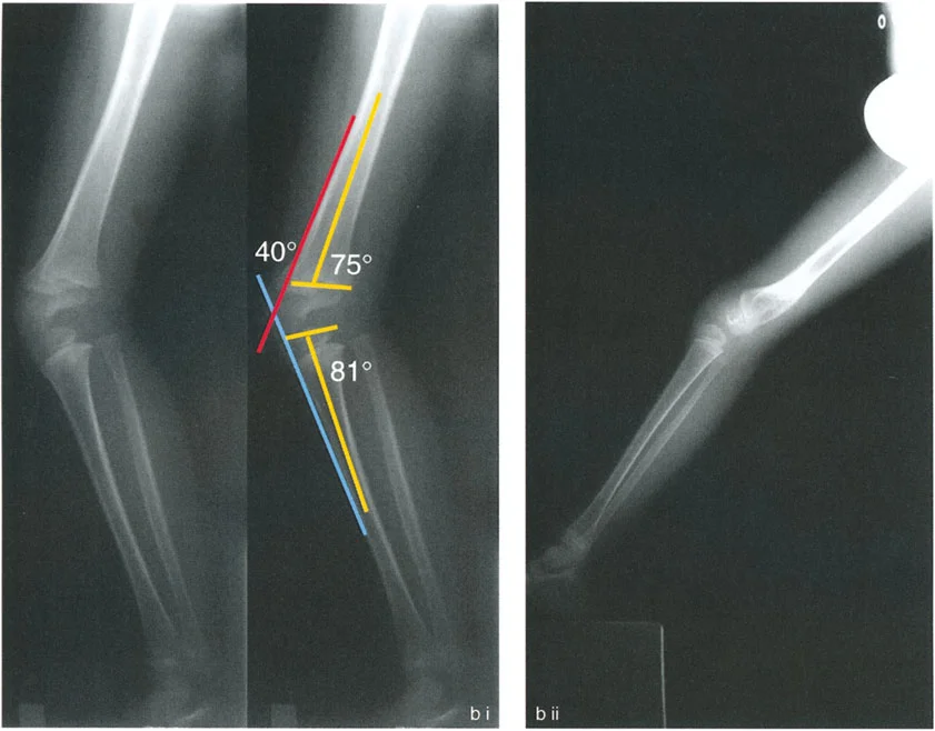 صورة طبية: جراحة إعادة تنظيم الركبة: حل متقدم لخشونة المفصل أحادي الحجرة وتشوهات الركبة