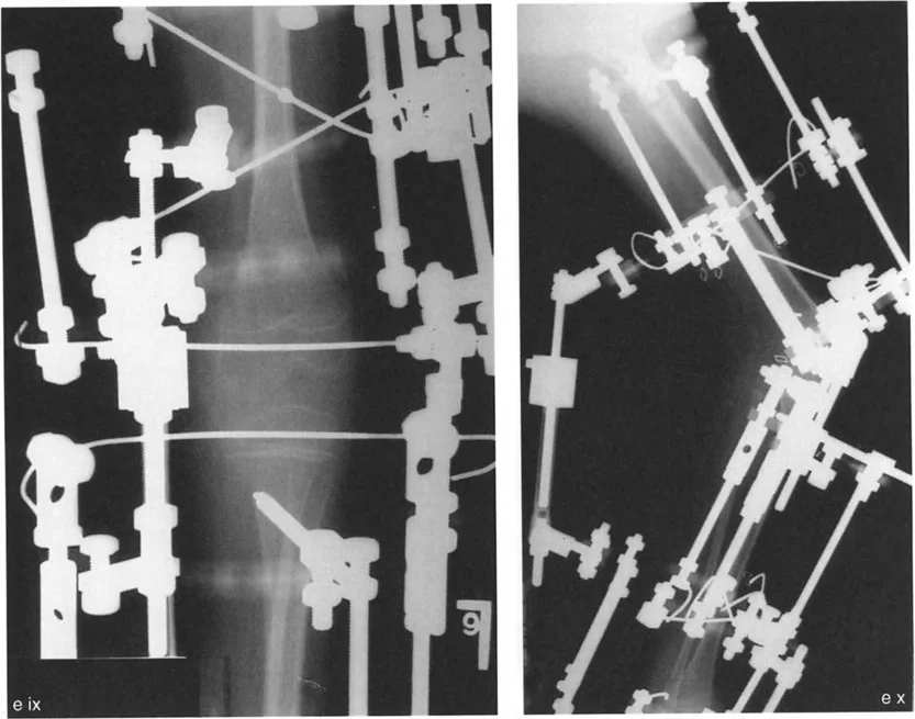 صورة طبية: جراحة إعادة تنظيم الركبة: حل متقدم لخشونة المفصل أحادي الحجرة وتشوهات الركبة