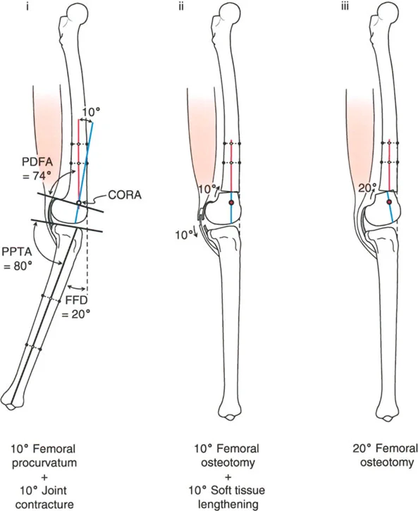 صورة طبية: جراحة إعادة تنظيم الركبة: حل متقدم لخشونة المفصل أحادي الحجرة وتشوهات الركبة