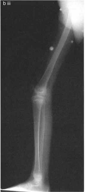 صورة طبية: جراحة إعادة تنظيم الركبة: حل متقدم لخشونة المفصل أحادي الحجرة وتشوهات الركبة