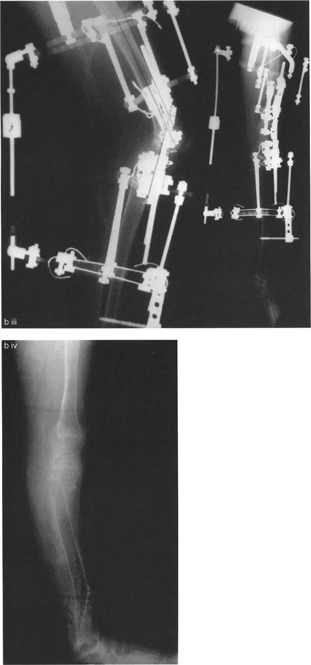 صورة طبية: جراحة إعادة تنظيم الركبة: حل متقدم لخشونة المفصل أحادي الحجرة وتشوهات الركبة
