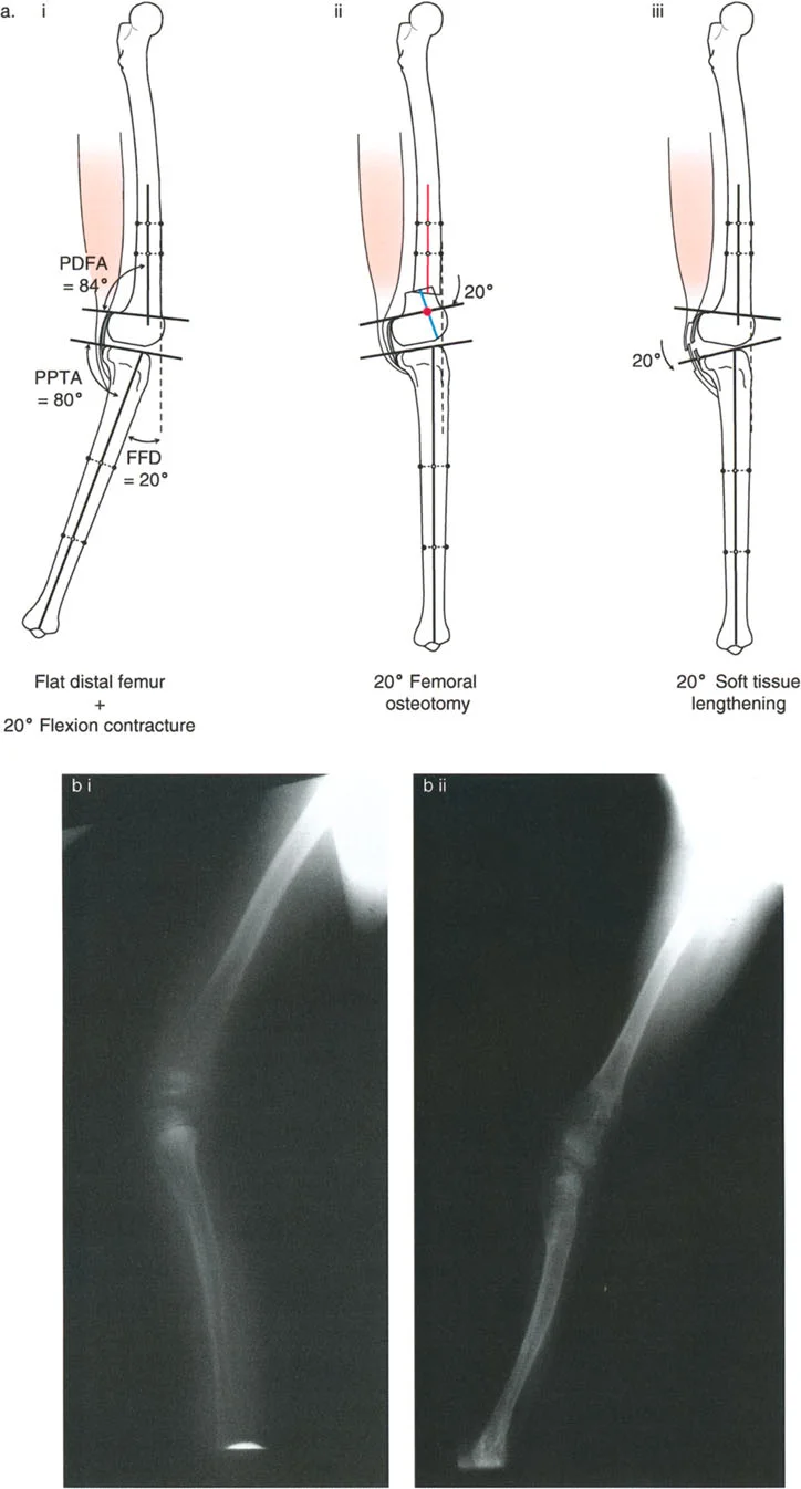 صورة طبية: جراحة إعادة تنظيم الركبة: حل متقدم لخشونة المفصل أحادي الحجرة وتشوهات الركبة