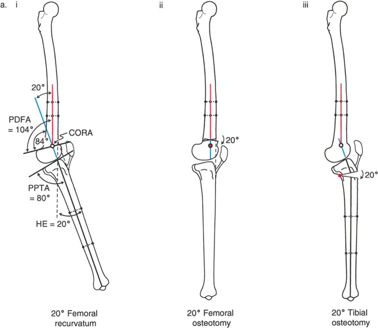 صورة طبية: جراحة إعادة تنظيم الركبة: حل متقدم لخشونة المفصل أحادي الحجرة وتشوهات الركبة
