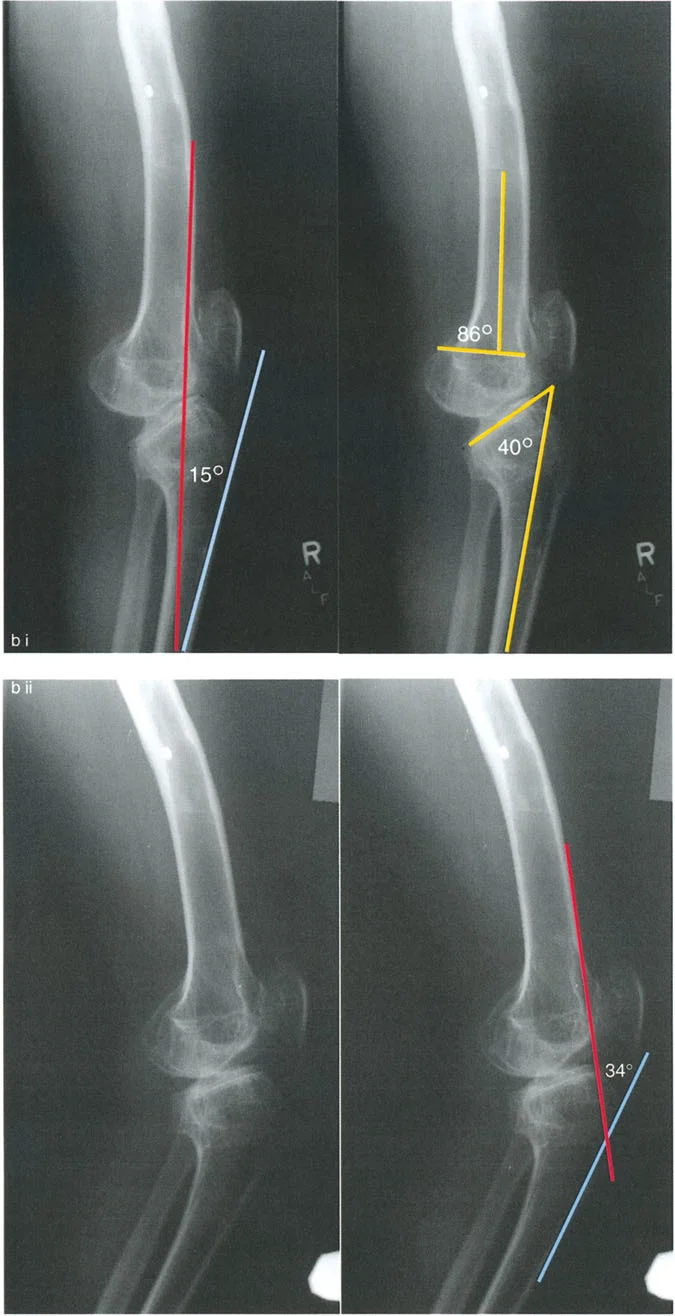 صورة طبية: جراحة إعادة تنظيم الركبة: حل متقدم لخشونة المفصل أحادي الحجرة وتشوهات الركبة