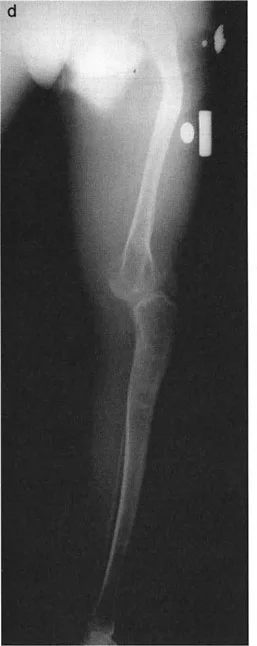 صورة طبية: جراحة إعادة تنظيم الركبة: حل متقدم لخشونة المفصل أحادي الحجرة وتشوهات الركبة