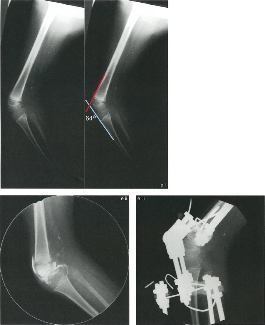 صورة طبية: جراحة إعادة تنظيم الركبة: حل متقدم لخشونة المفصل أحادي الحجرة وتشوهات الركبة