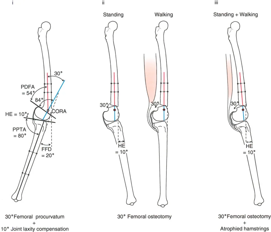 صورة طبية: جراحة إعادة تنظيم الركبة: حل متقدم لخشونة المفصل أحادي الحجرة وتشوهات الركبة
