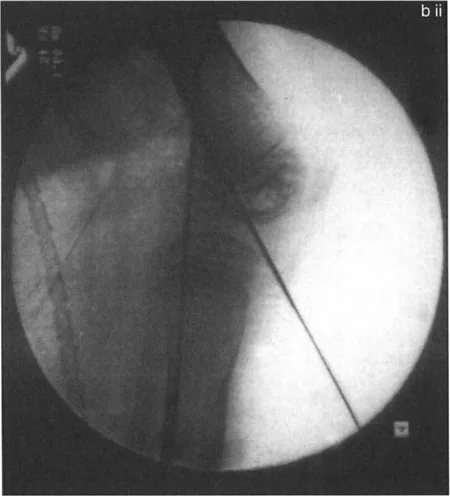 صورة طبية: جراحة إعادة تنظيم الركبة: حل متقدم لخشونة المفصل أحادي الحجرة وتشوهات الركبة