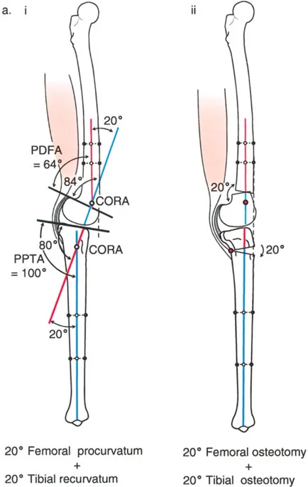 صورة طبية: جراحة إعادة تنظيم الركبة: حل متقدم لخشونة المفصل أحادي الحجرة وتشوهات الركبة