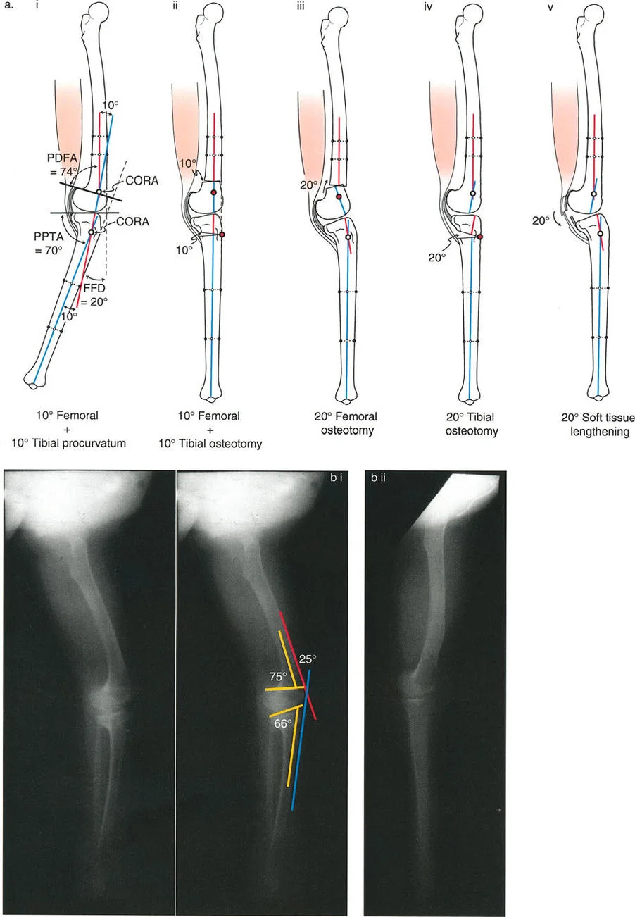 صورة طبية: جراحة إعادة تنظيم الركبة: حل متقدم لخشونة المفصل أحادي الحجرة وتشوهات الركبة