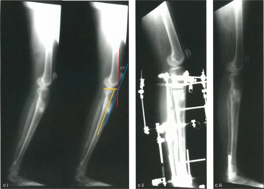صورة طبية: جراحة إعادة تنظيم الركبة: حل متقدم لخشونة المفصل أحادي الحجرة وتشوهات الركبة