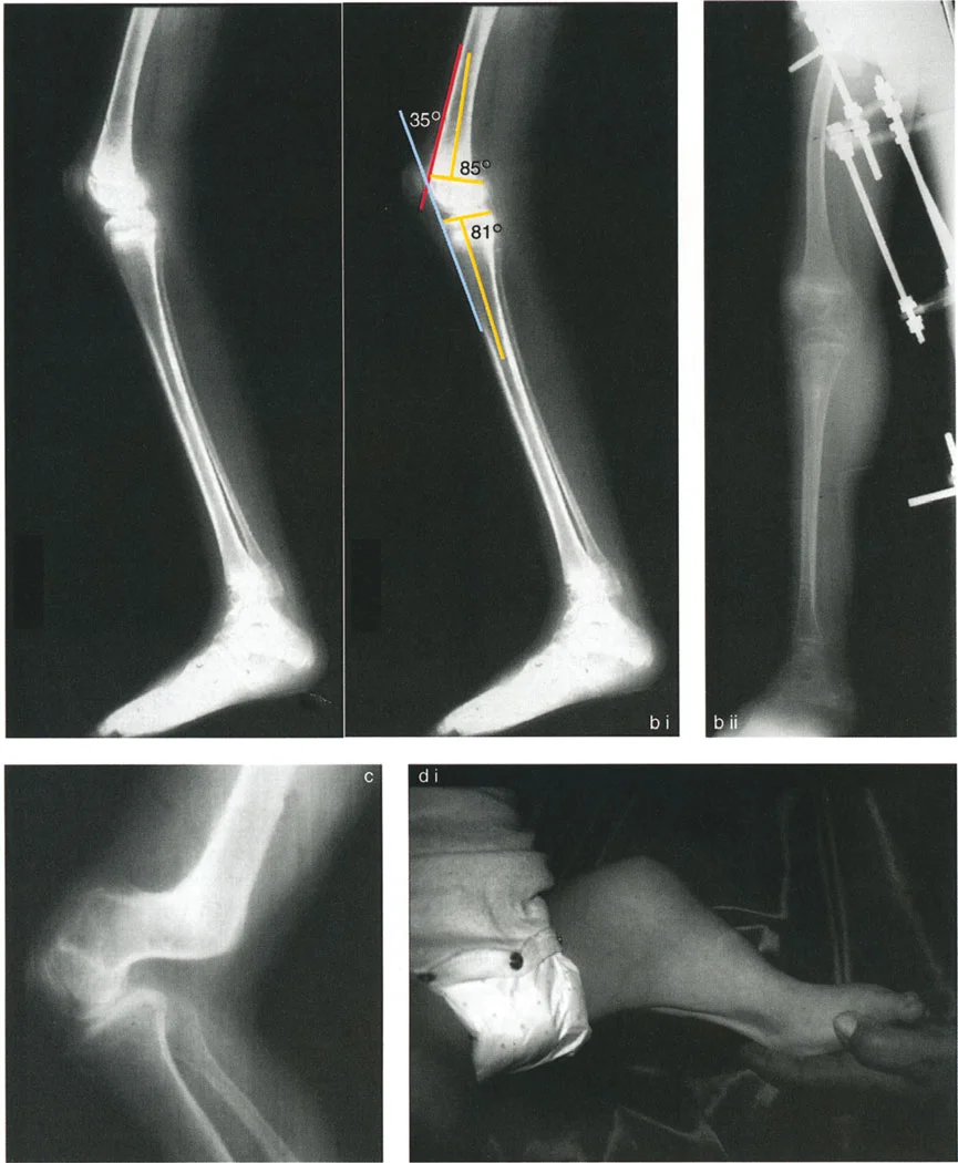 صورة طبية: جراحة إعادة تنظيم الركبة: حل متقدم لخشونة المفصل أحادي الحجرة وتشوهات الركبة