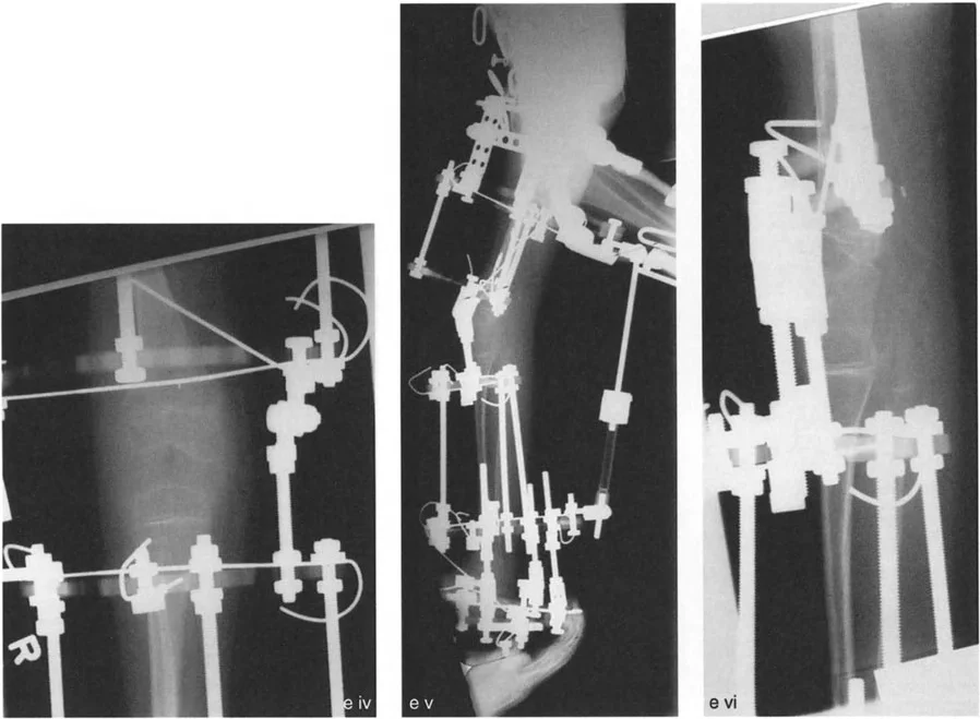 صورة طبية: جراحة إعادة تنظيم الركبة: حل متقدم لخشونة المفصل أحادي الحجرة وتشوهات الركبة