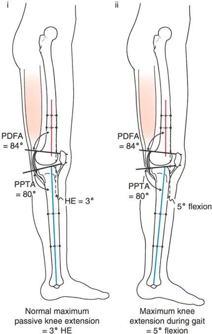صورة طبية: جراحة إعادة تنظيم الركبة: حل متقدم لخشونة المفصل أحادي الحجرة وتشوهات الركبة