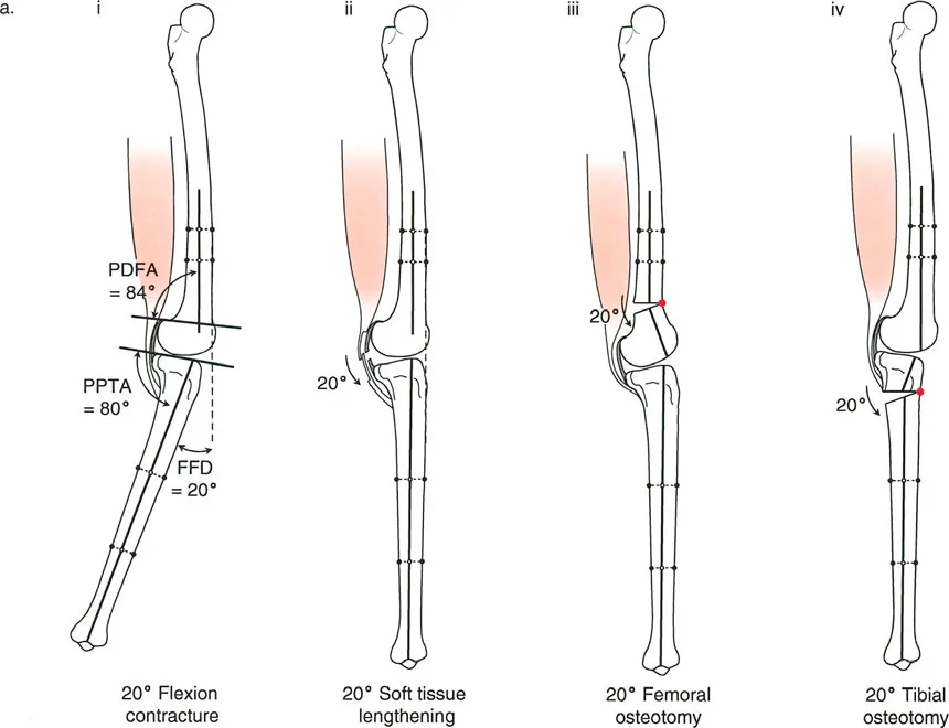 صورة طبية: جراحة إعادة تنظيم الركبة: حل متقدم لخشونة المفصل أحادي الحجرة وتشوهات الركبة