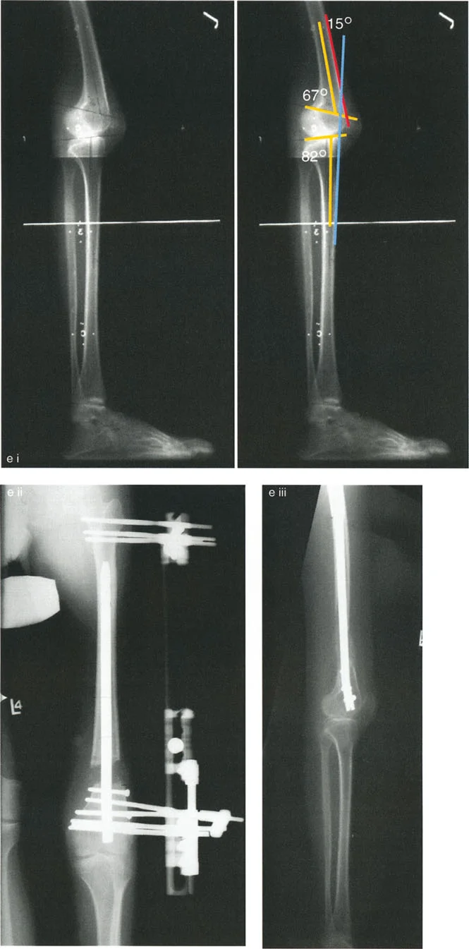 صورة توضيحية لـ جراحة إعادة تنظيم الركبة: حل متقدم لخشونة المفصل أحادي الحجرة وتشوهات الركبة